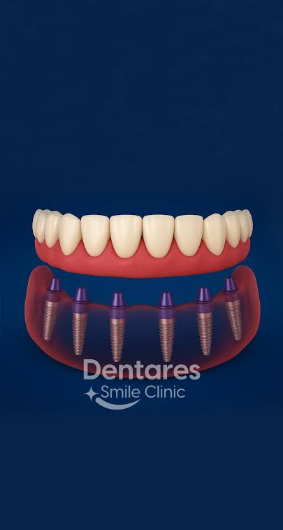 Dental Implants